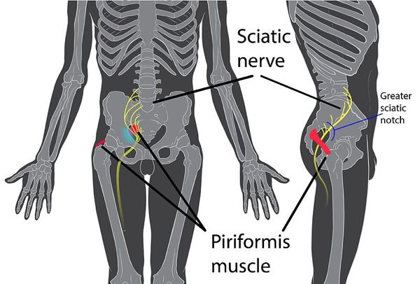 Piriformis Syndrome